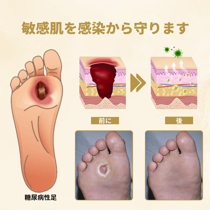 🔥🔥【公式ブランドショップ】Timilk® 蜂毒配合・糖尿病足用治癒スプレー
