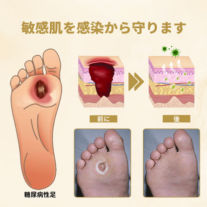 🔥🔥【公式ブランドショップ】Timilk® 蜂毒配合・糖尿病足用治癒スプレー