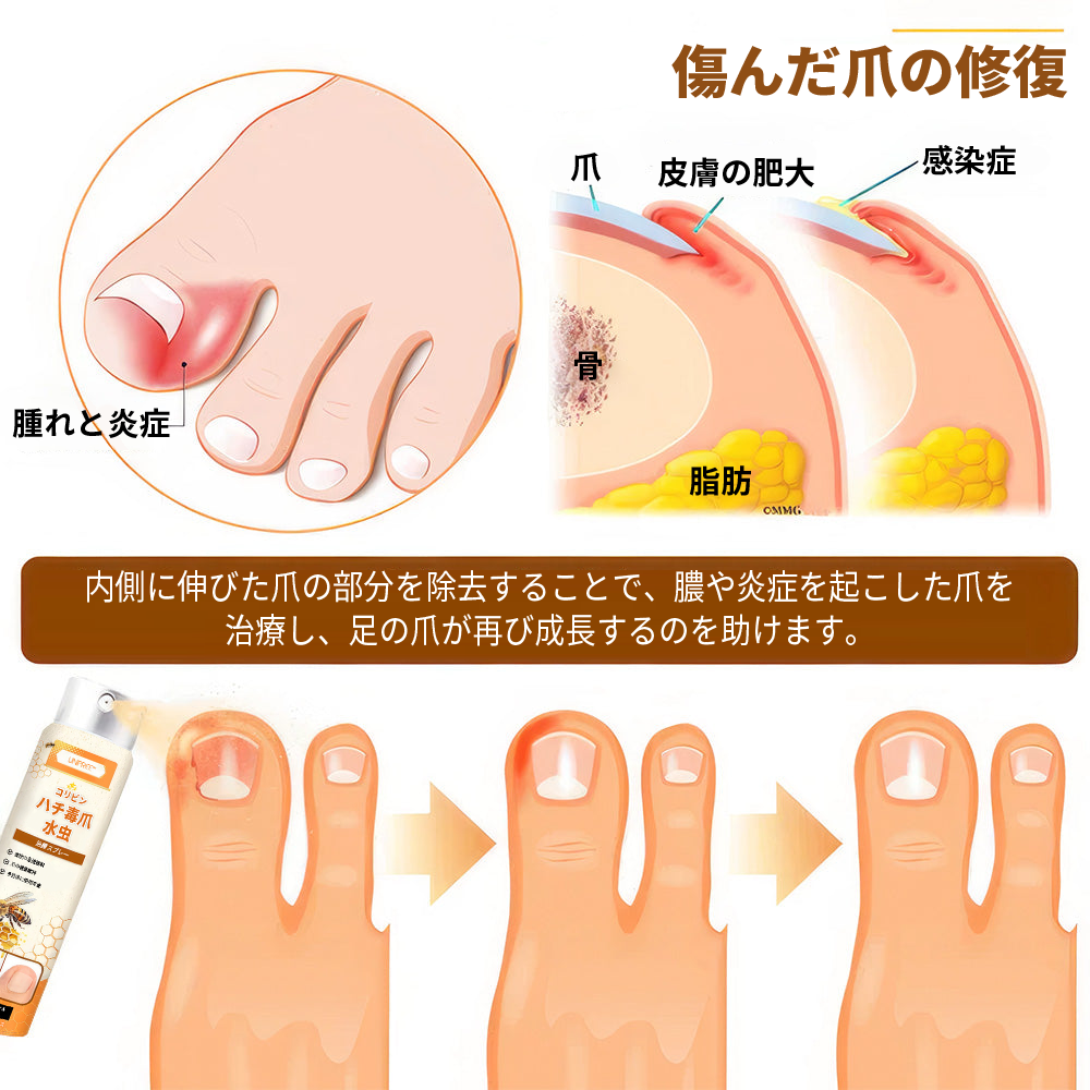 💥💥 2025年限定 70%OFF ⏳ UNPREE™ Kolirin ビーベノム爪真菌スプレー 💥 わずか2週間で爪のトラブルをすべて解消！