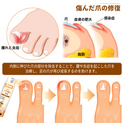 💥💥 2025年限定 70%OFF ⏳ UNPREE™ Kolirin ビーベノム爪真菌スプレー 💥 わずか2週間で爪のトラブルをすべて解消！