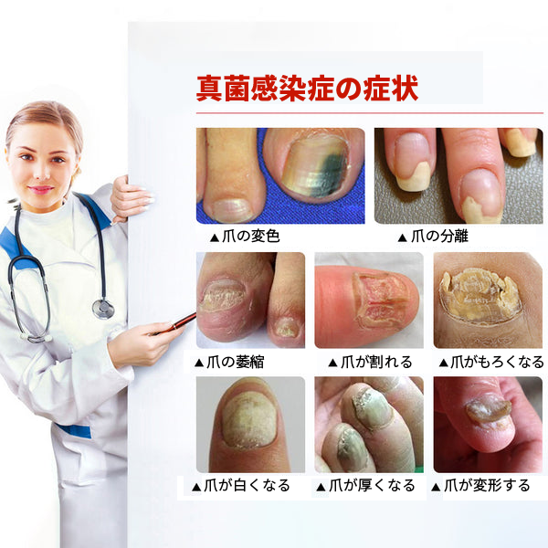 💥💥 2025年限定 70%OFF ⏳ UNPREE™ Kolirin ビーベノム爪真菌スプレー 💥 わずか2週間で爪のトラブルをすべて解消！