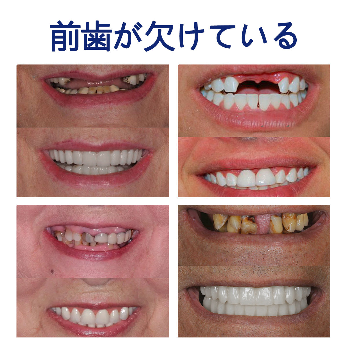 Bikenda® シリコーン義歯定規セット（✅ 試験済み・信頼の品質・歯科医師推奨）🔥